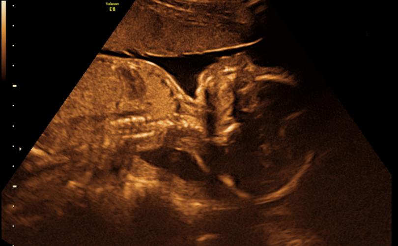 ultrasound_unborn_baby_810_500_s_c1