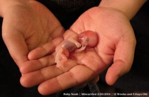 12 week fetus